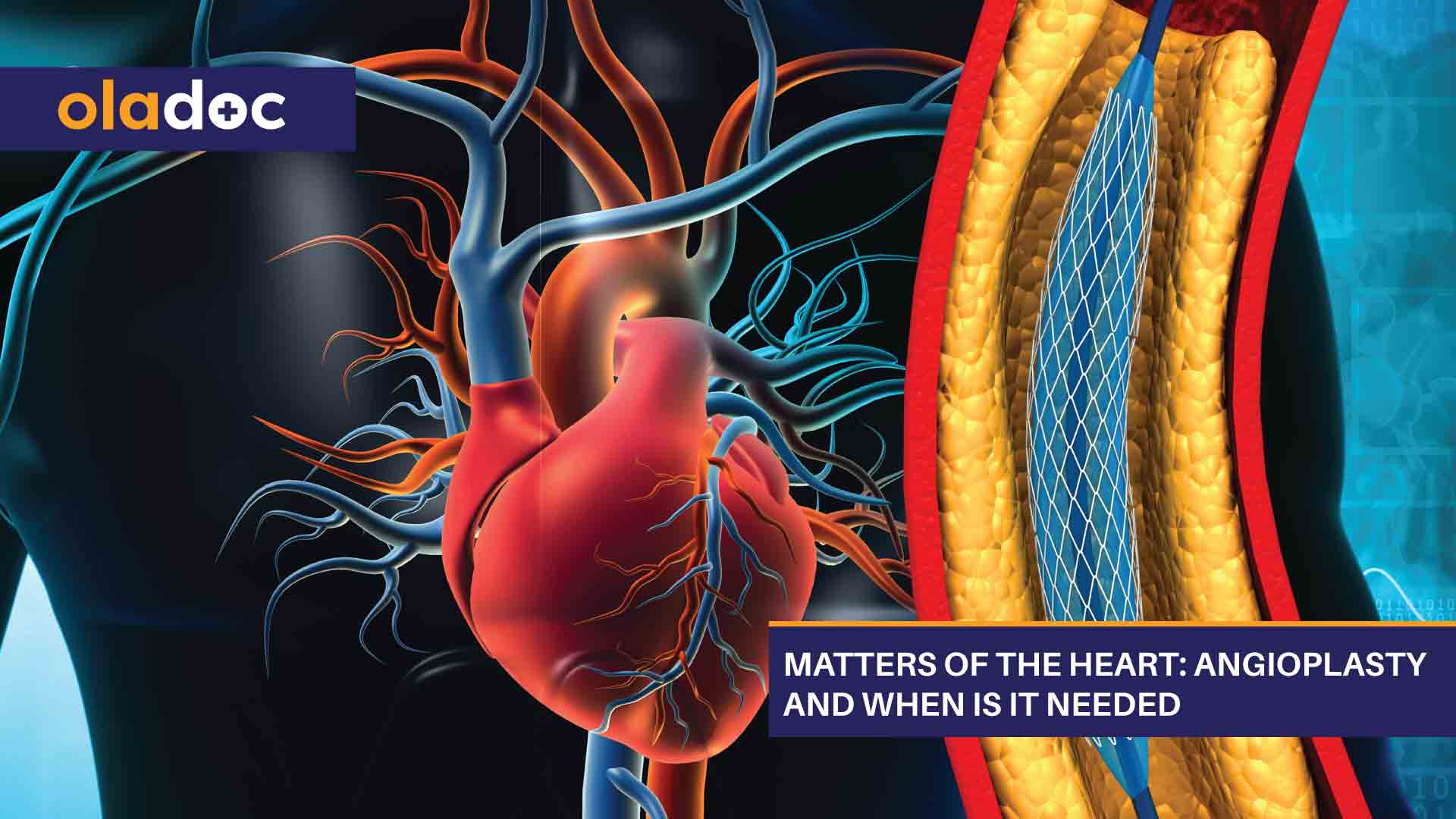 Matters Of The Heart: Angioplasty And When Is It Needed thumbnail
