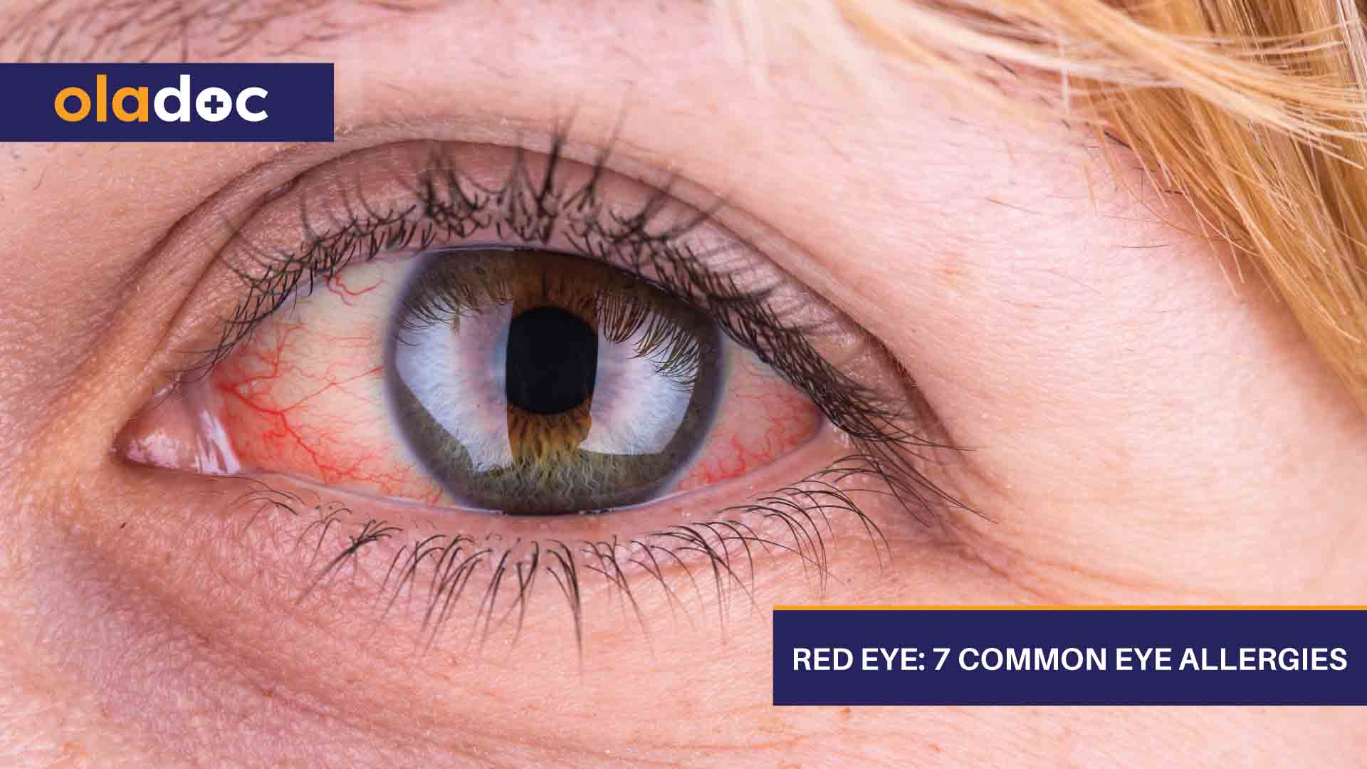 Red Eye: 7 Common Eye Allergies thumbnail
