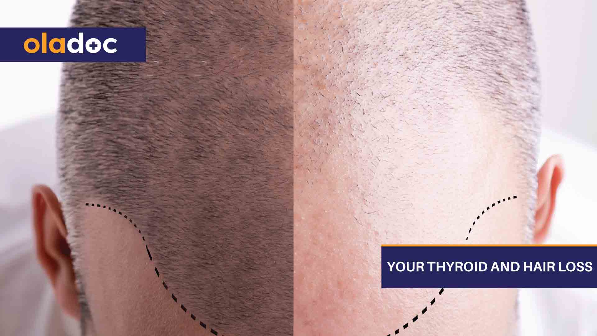 Your-Thyroid-And-Hair-Loss