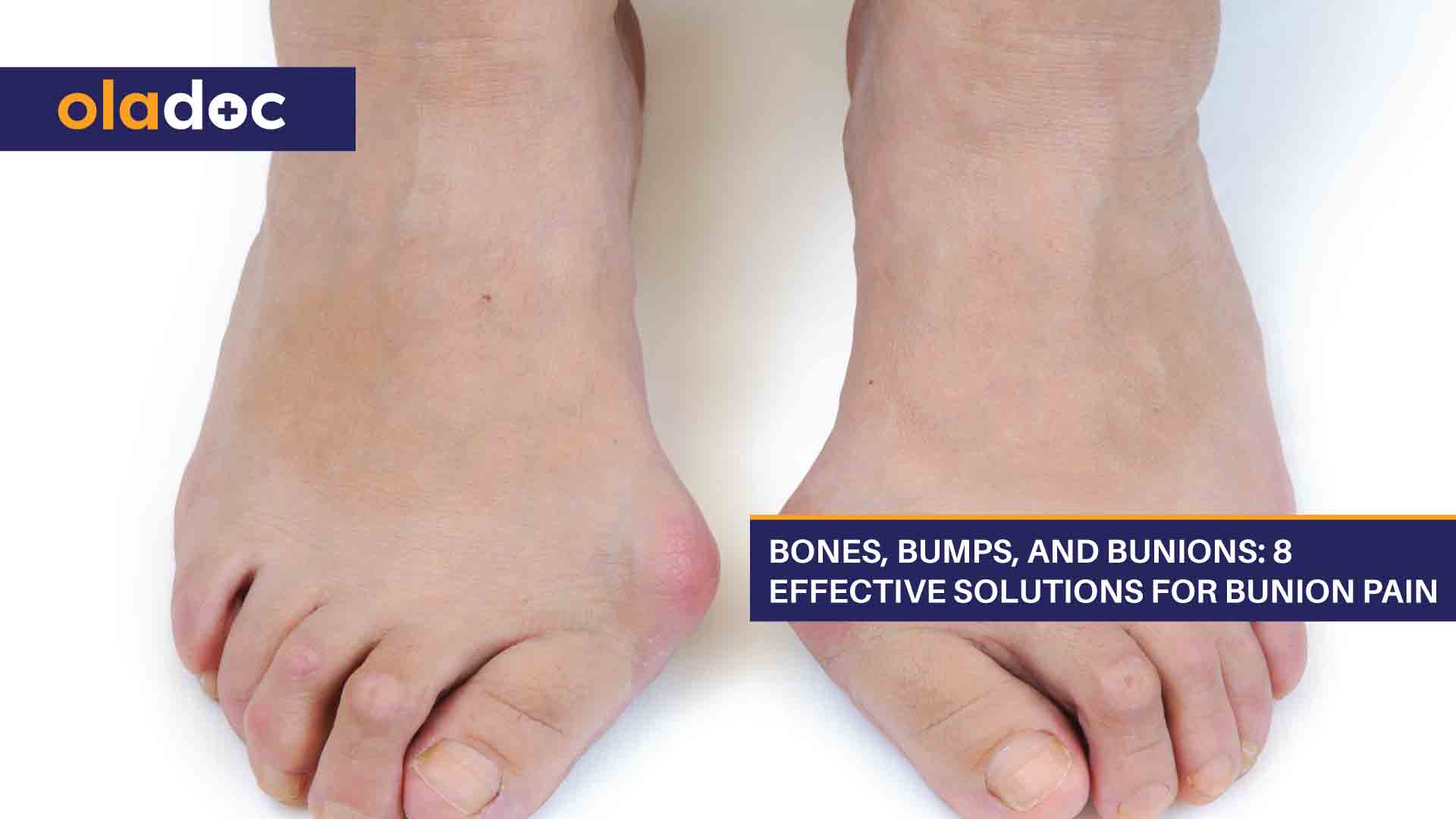 Bones, Bumps, and Bunions: 8 Effective Solutions for Bunion Pain thumbnail