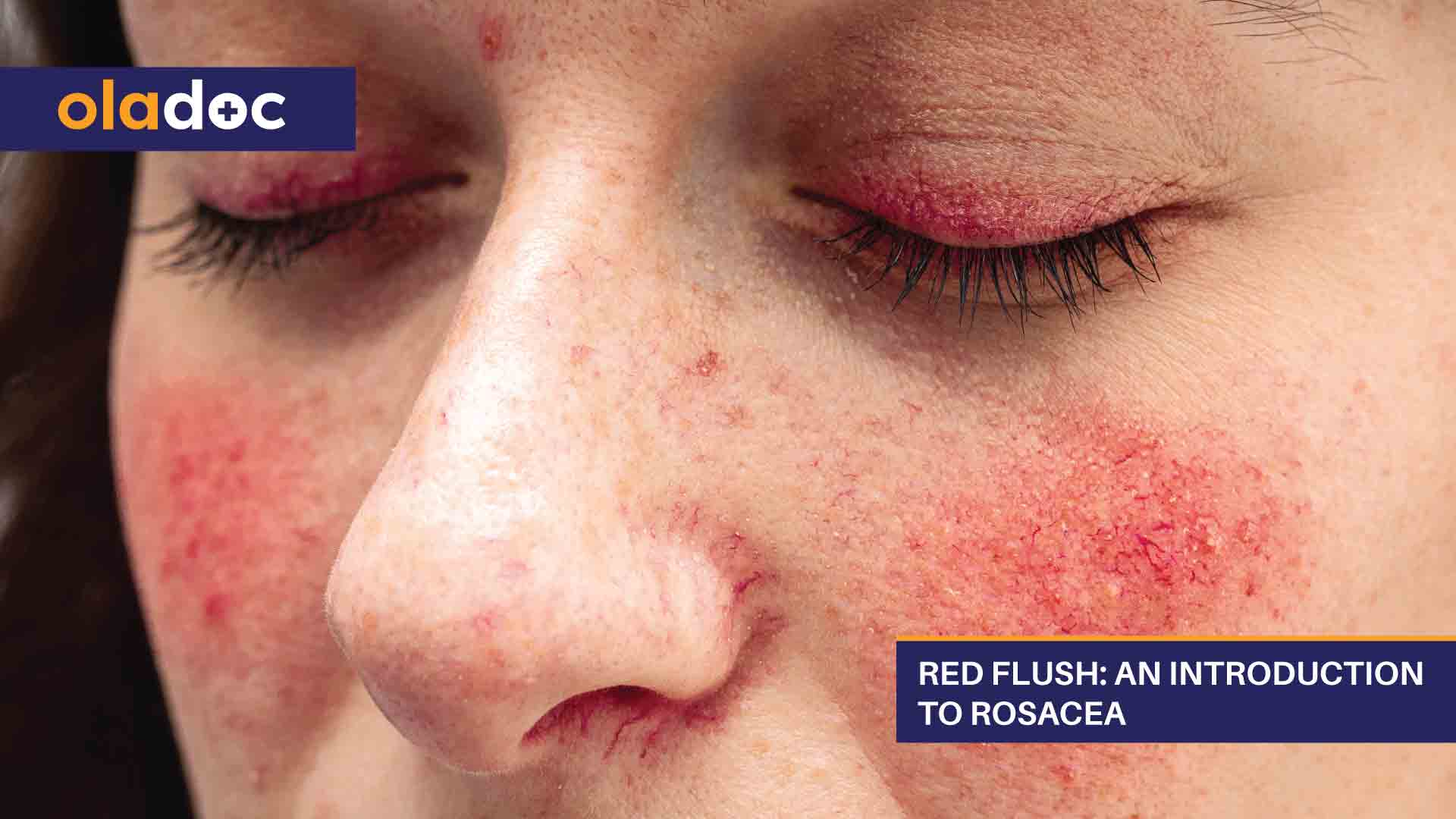 Red Flush: An Introduction to Rosacea thumbnail