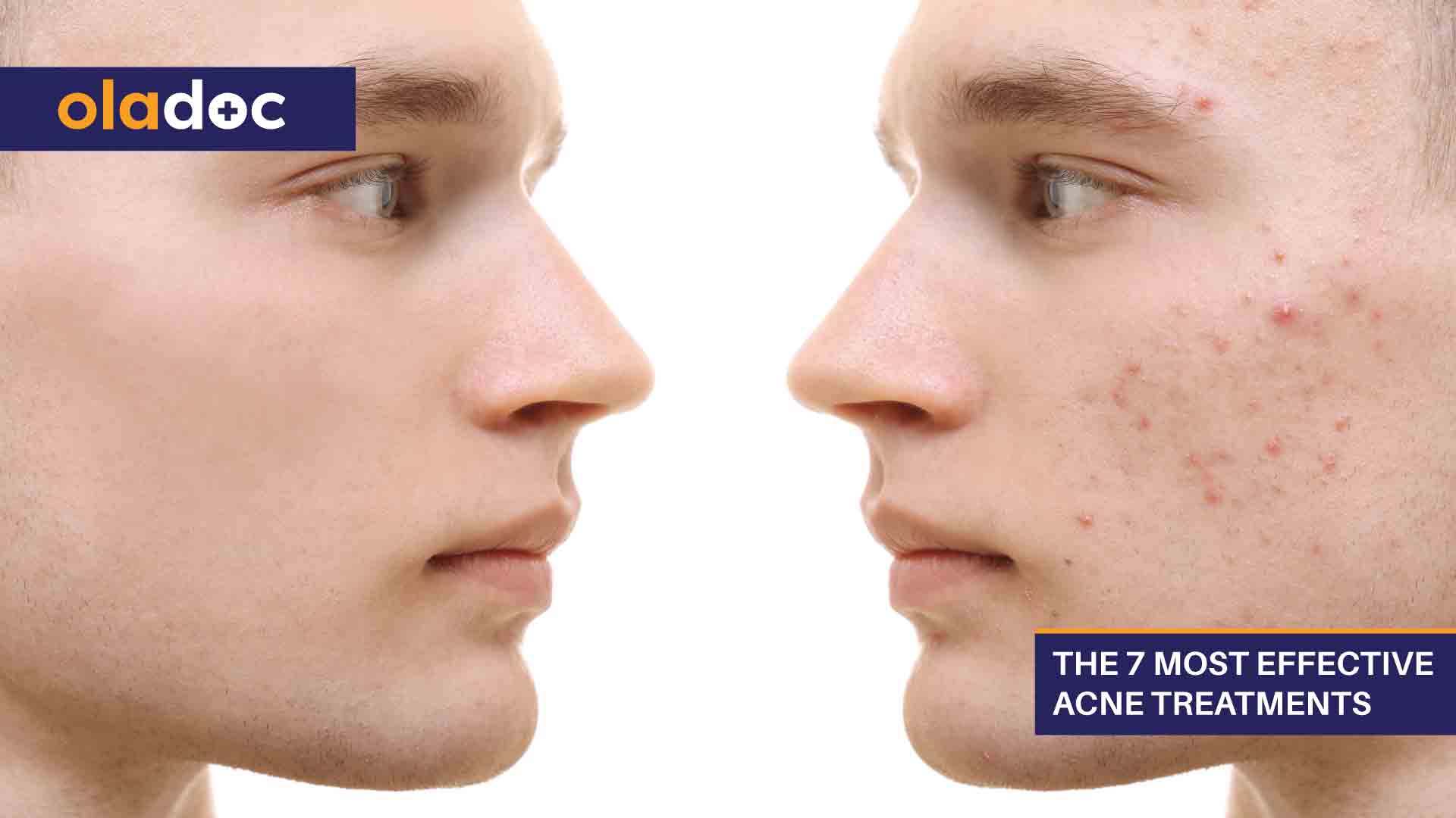 The 7 Most Effective Acne Treatments thumbnail