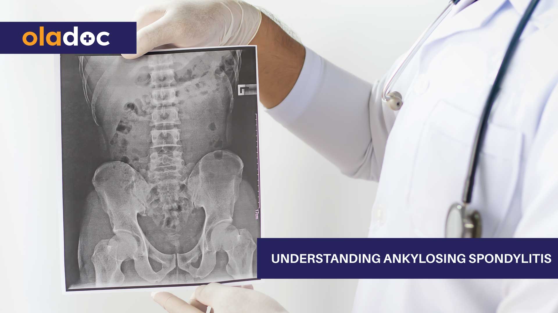 Understanding Ankylosing Spondylitis thumbnail