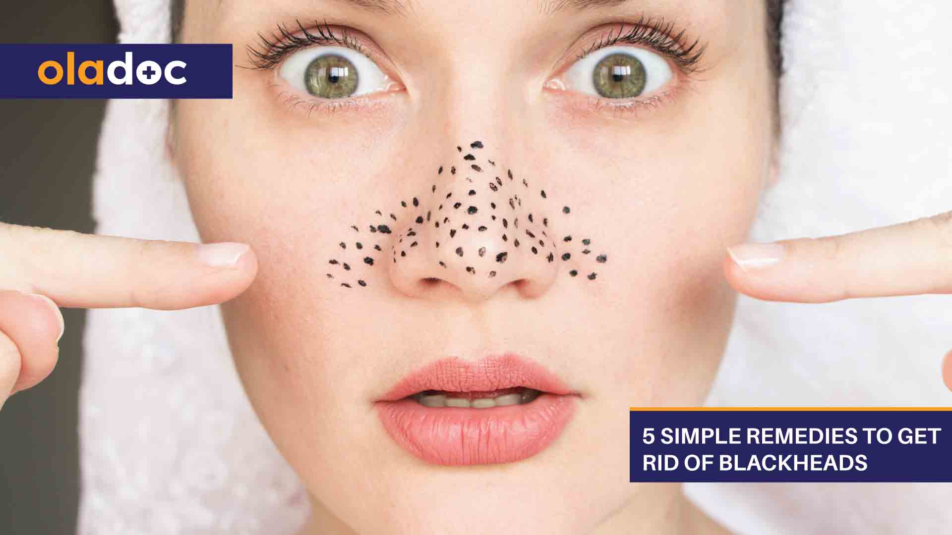 5 Simple Home Remedies to Get Rid of Blackheads thumbnail
