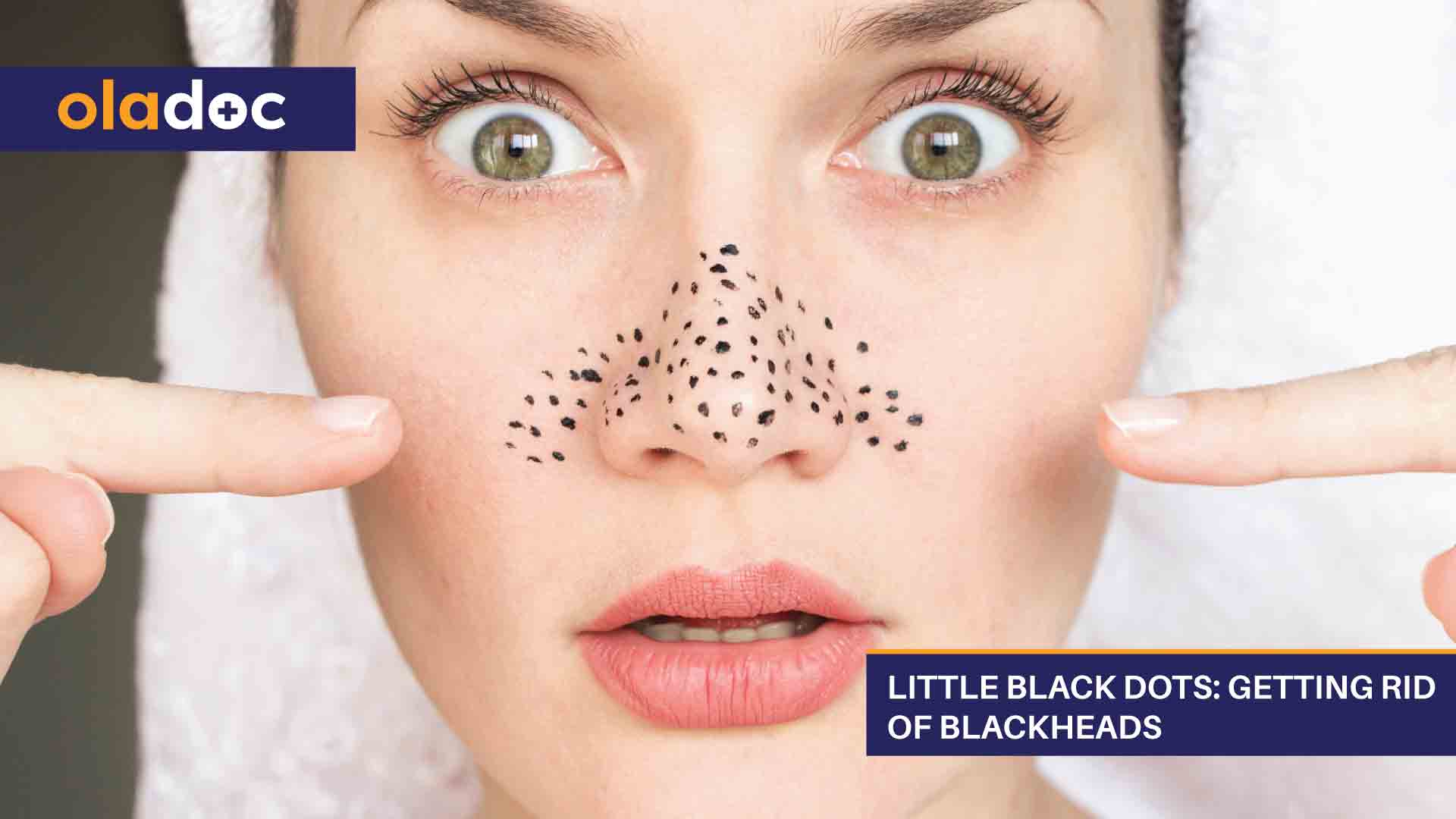 Little Black Dots: Getting Rid of Blackheads thumbnail