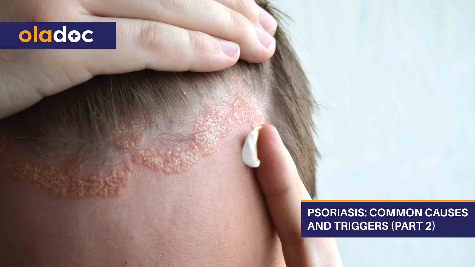 Psoriasis: Common Causes and Triggers (Part 2) thumbnail