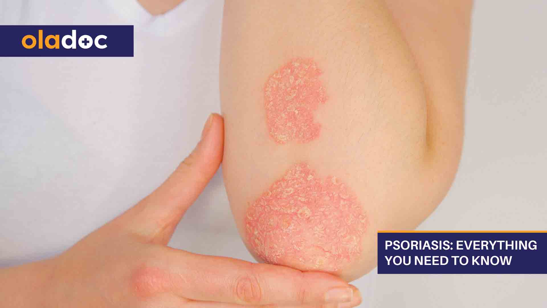 Psoriasis: Everything You Need to Know thumbnail