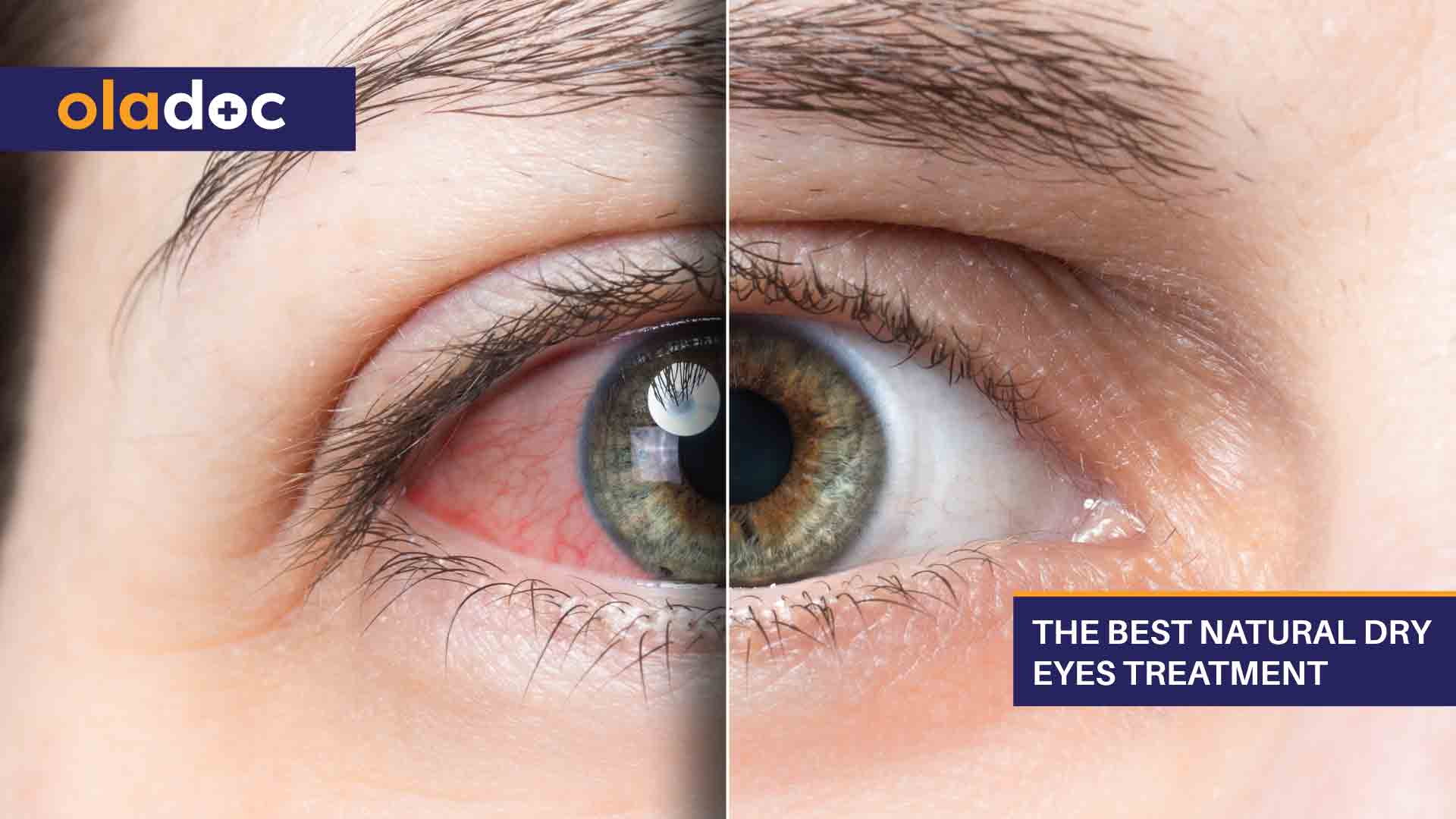The Best Natural Dry Eyes Treatment thumbnail