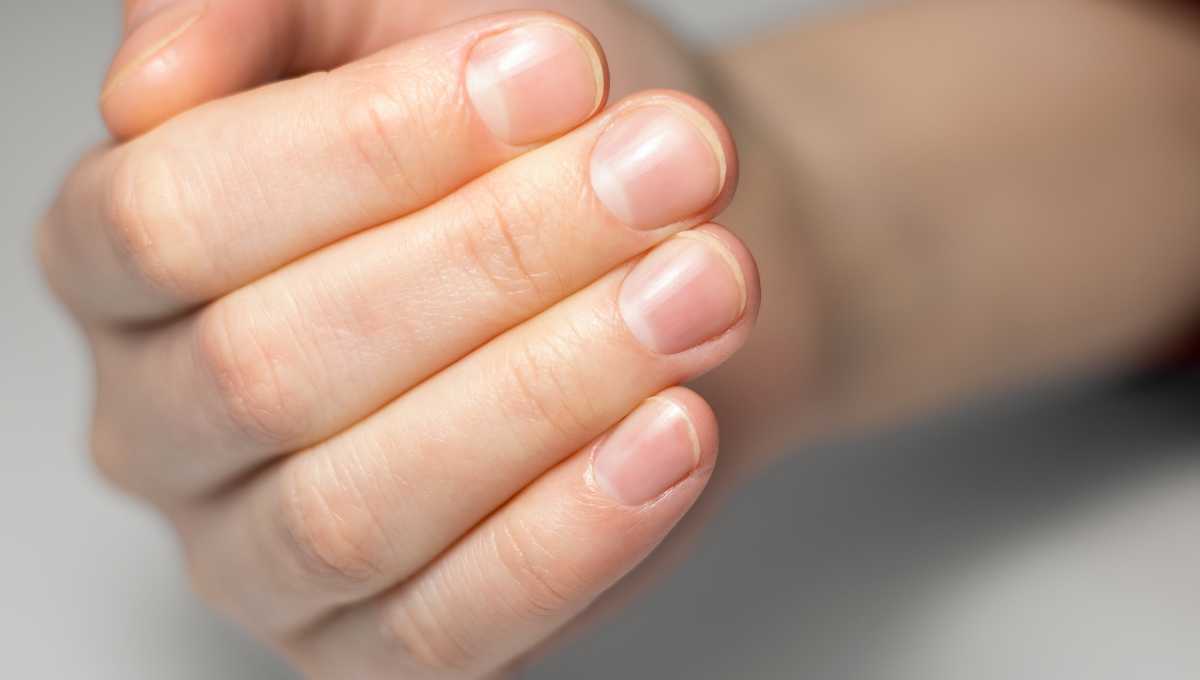 6 Natural Remedies to Strengthen Brittle Nails thumbnail