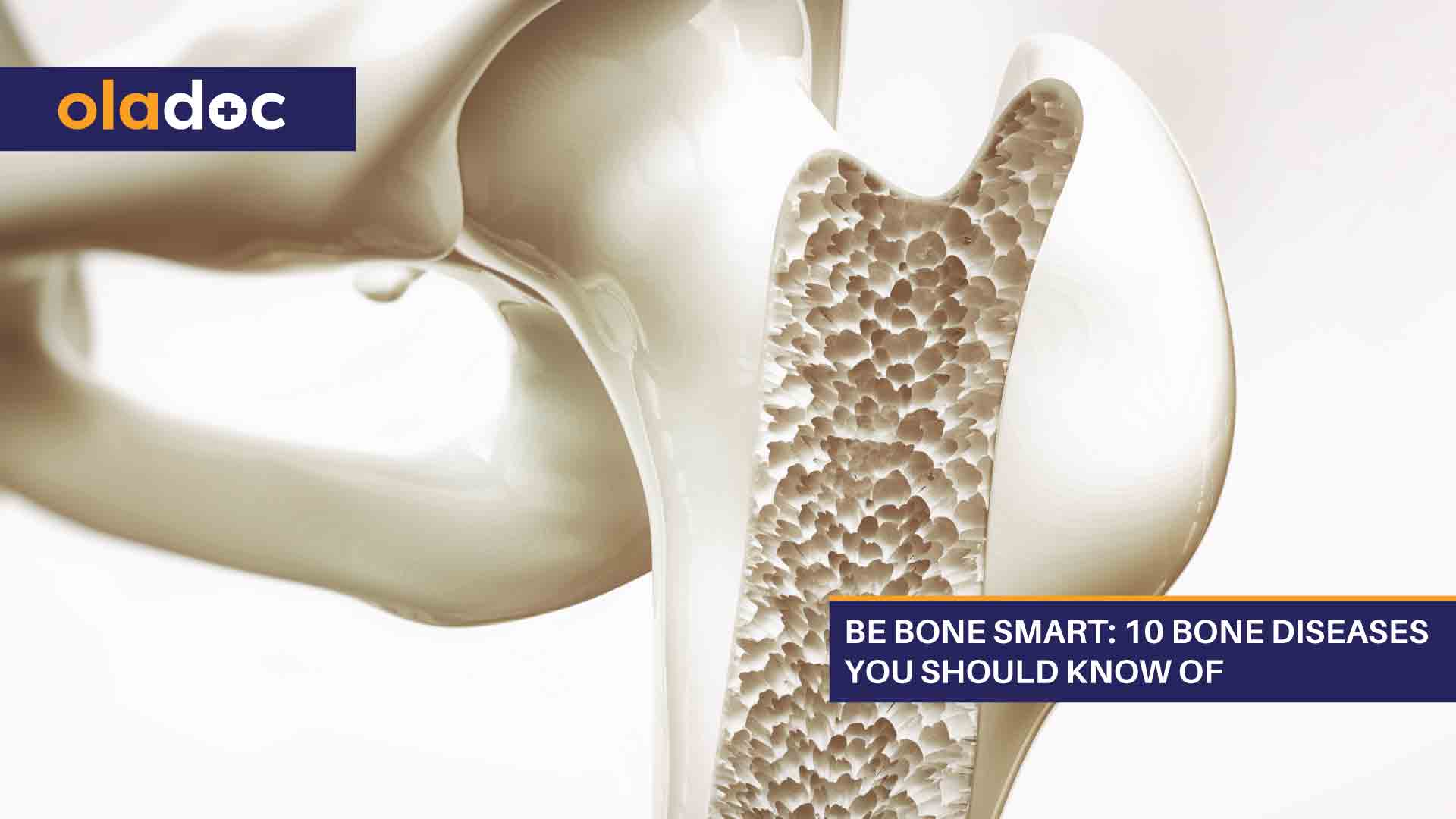 Be Bone Smart: 10 Bone Diseases You Should Know Of thumbnail