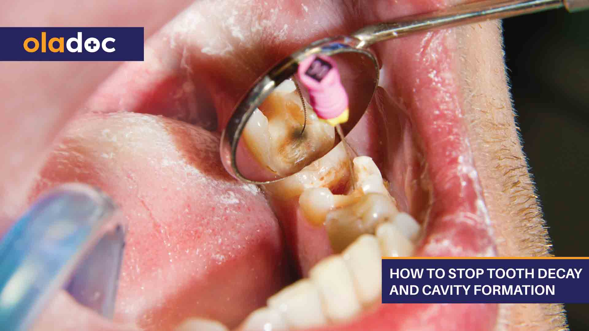 How to Stop Tooth Decay and Cavity Formation thumbnail