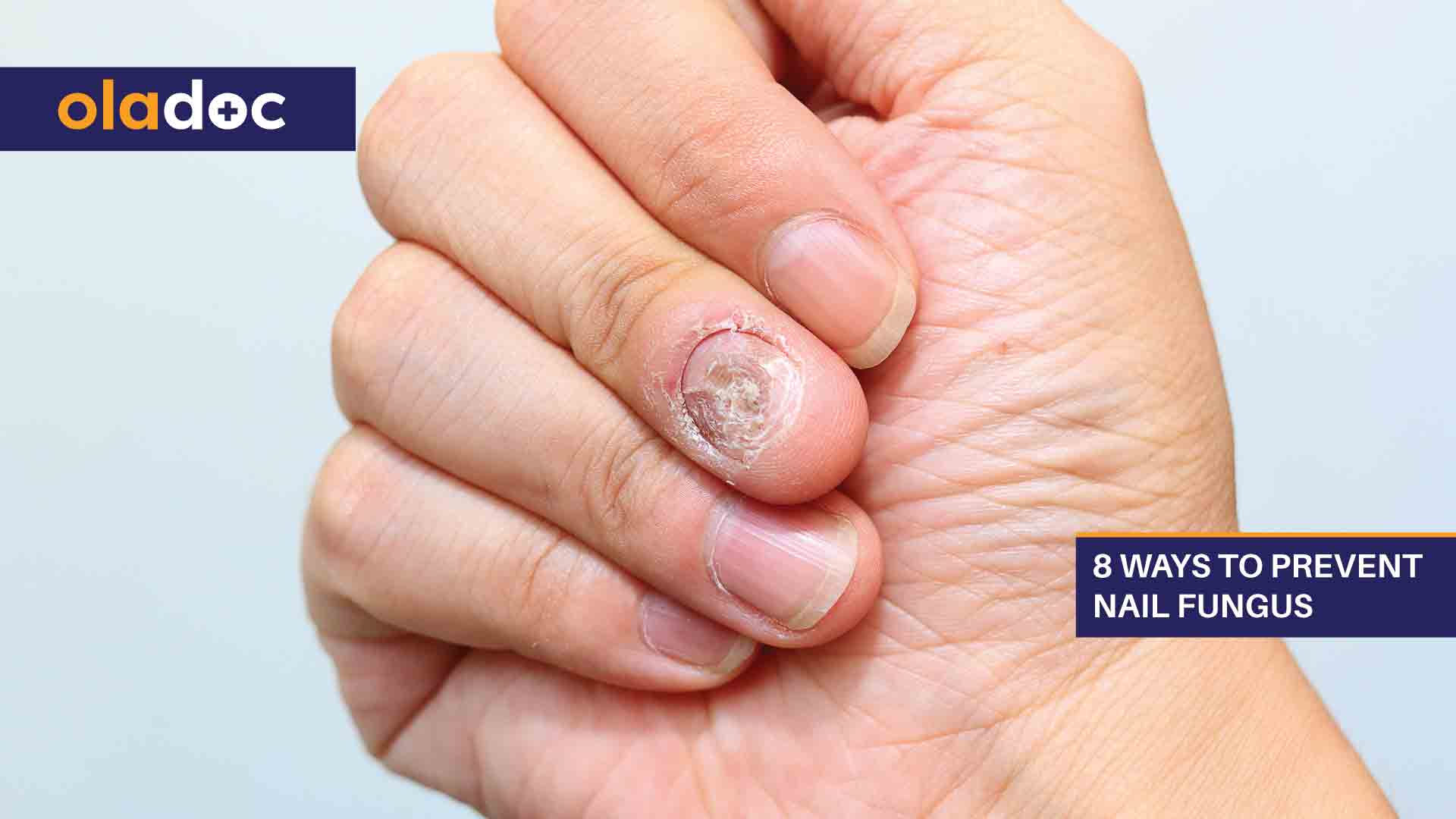 8 Effective Ways to Prevent Nail Fungus thumbnail