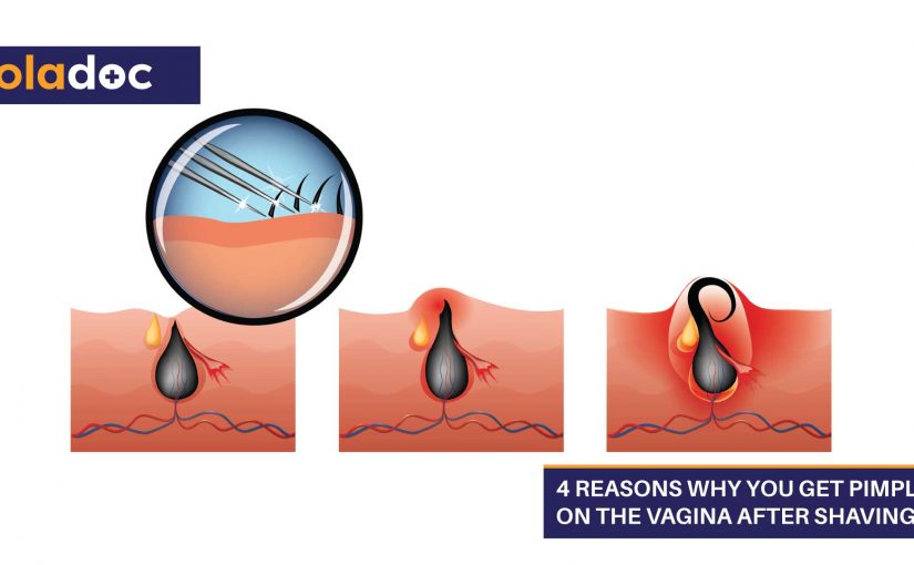 Why is My Vagina Itchy and How Do I Fix It  DrFormulas