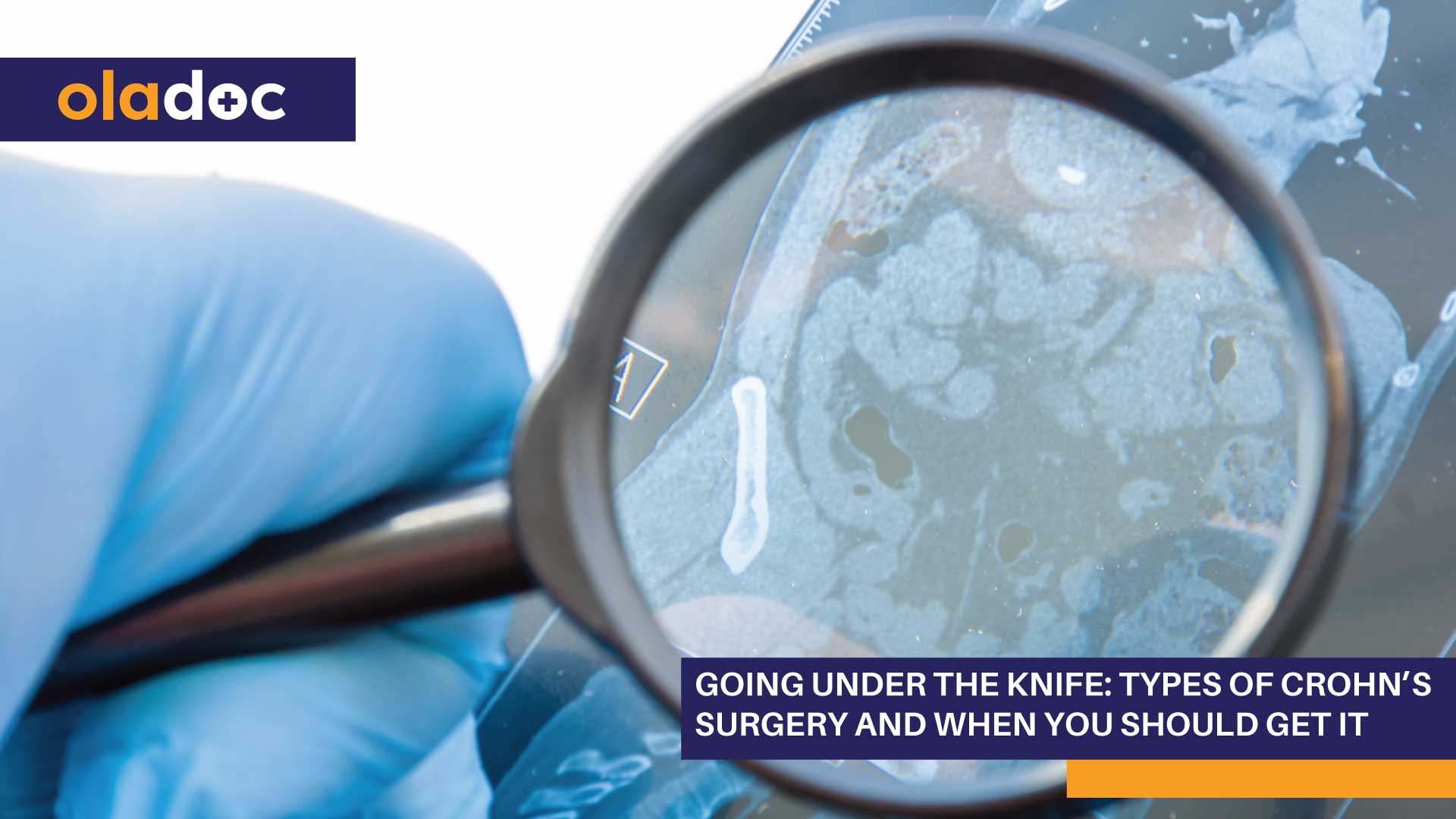 Going Under the Knife: Types of Crohn’s Surgery and When You Should Get It thumbnail