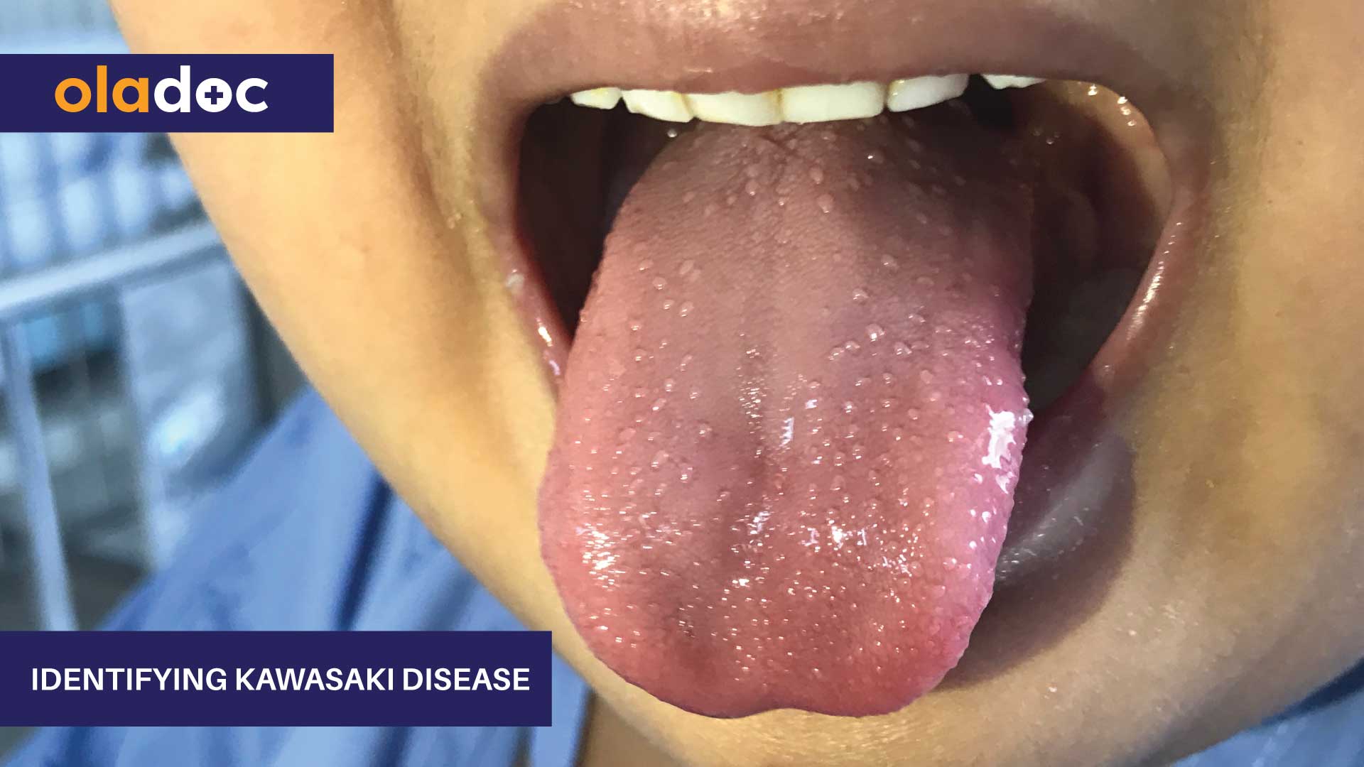 Identifying Kawasaki Disease thumbnail