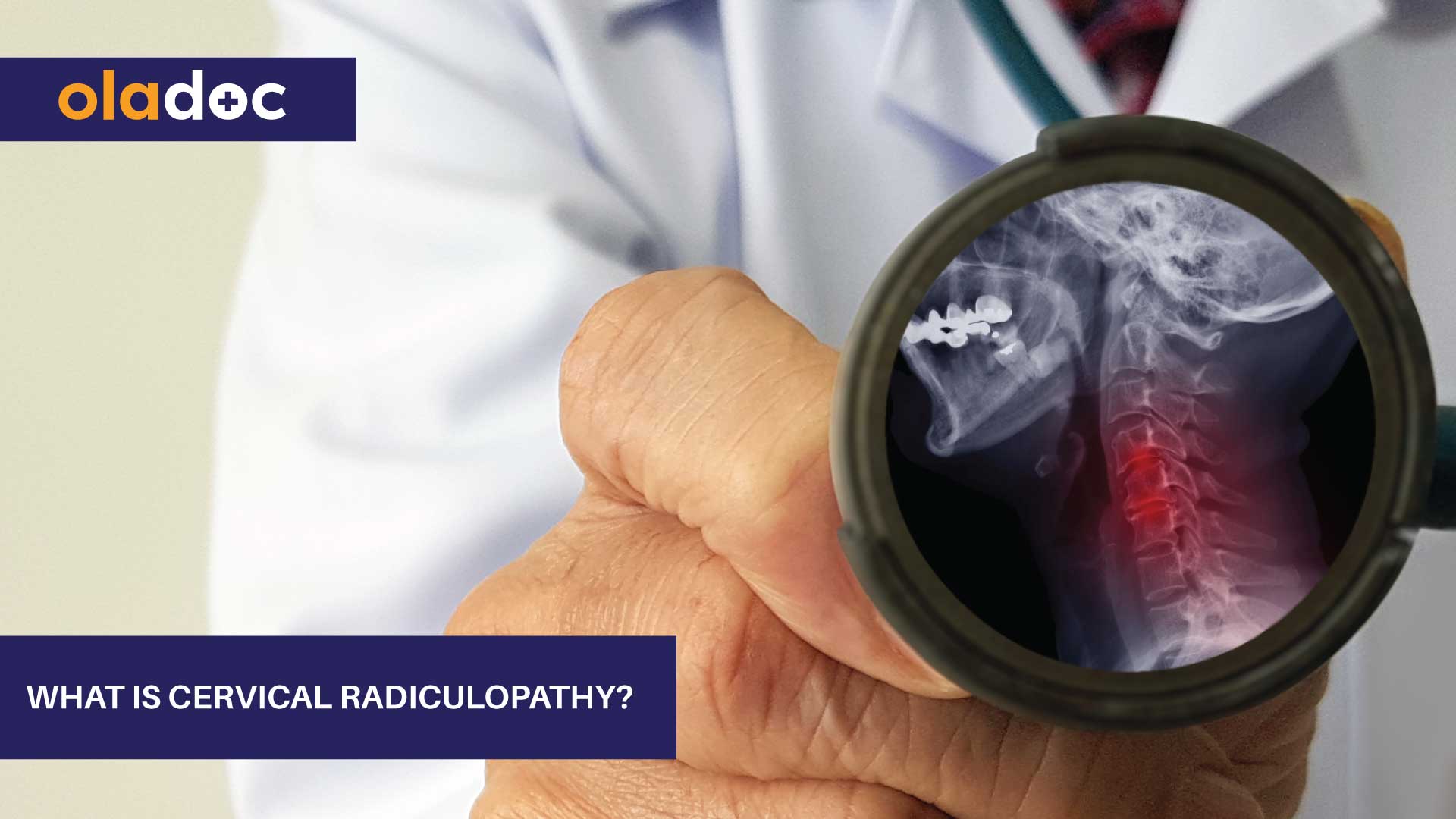 What Is Cervical Radiculopathy? thumbnail