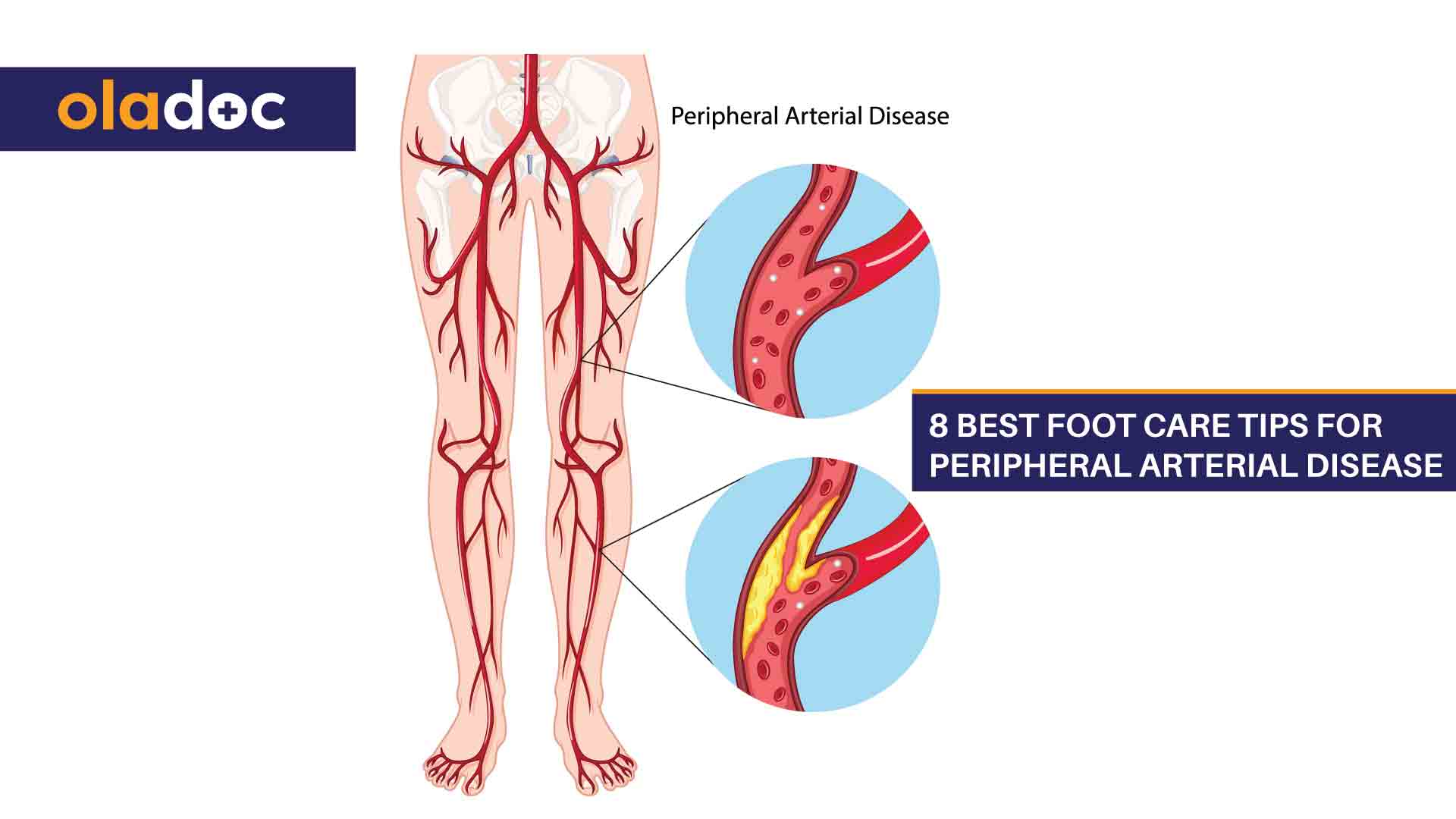 8 Best Foot Care Tips for Peripheral Arterial Disease thumbnail