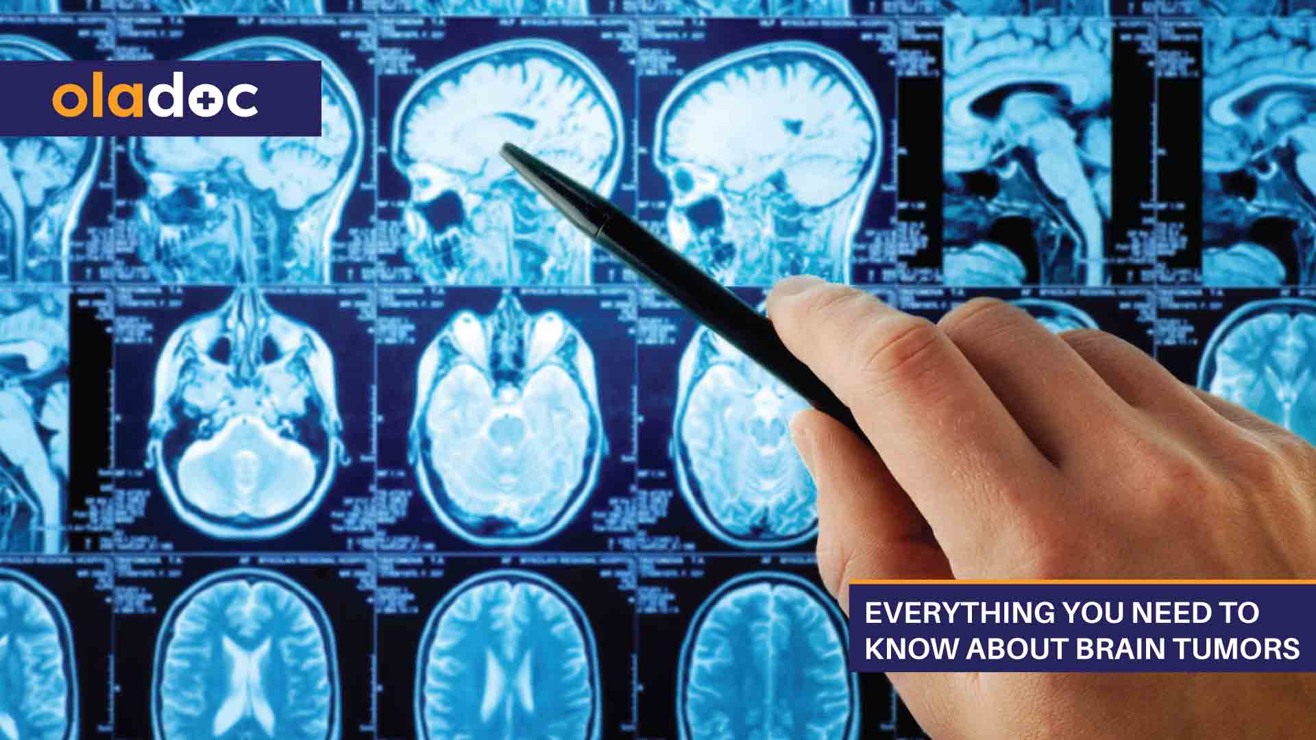 Everything You Need to Know About Brain Tumors thumbnail
