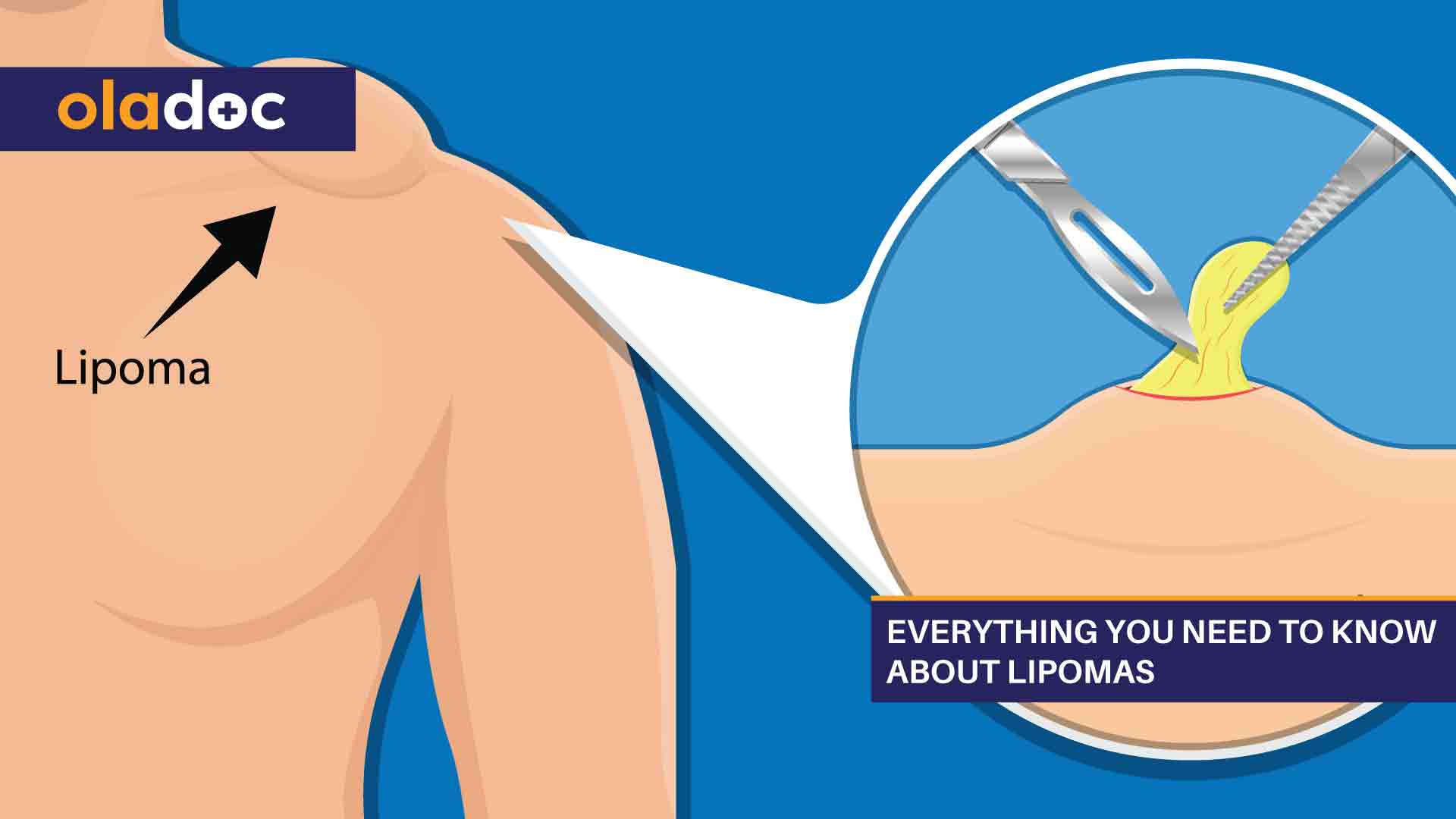 Everything You Need to Know About Lipomas thumbnail