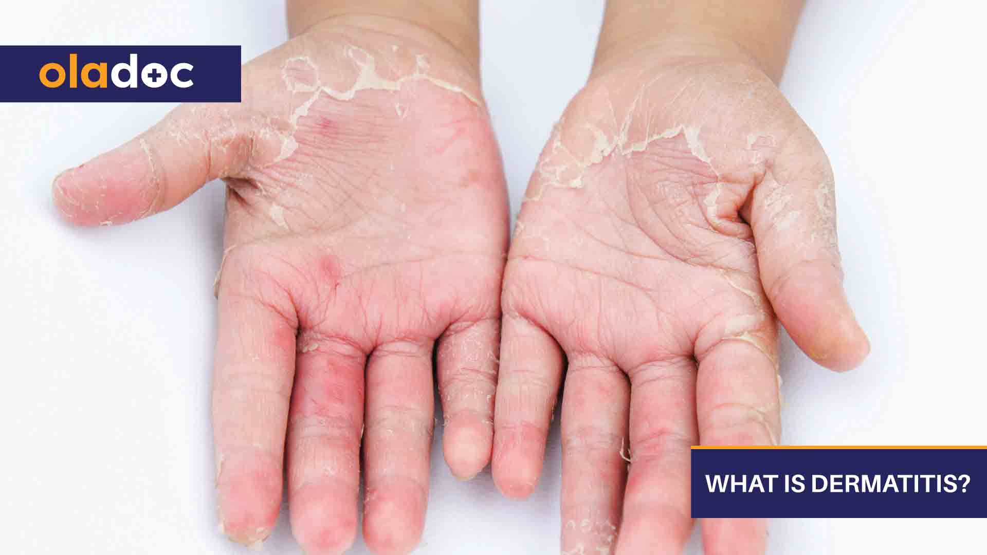 What Is Dermatitis? thumbnail
