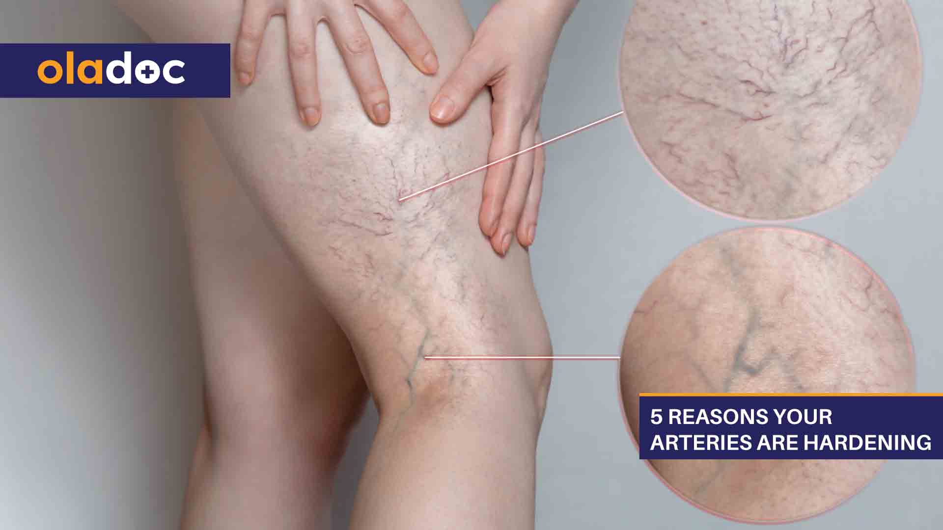 5 Reasons Your Arteries Are Hardening thumbnail