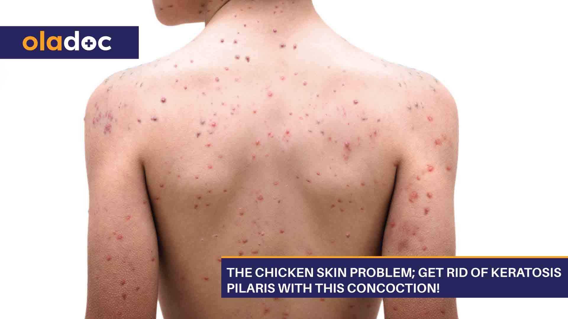 The Chicken Skin Problem; Get Rid of Keratosis Pilaris With This Concoction! thumbnail