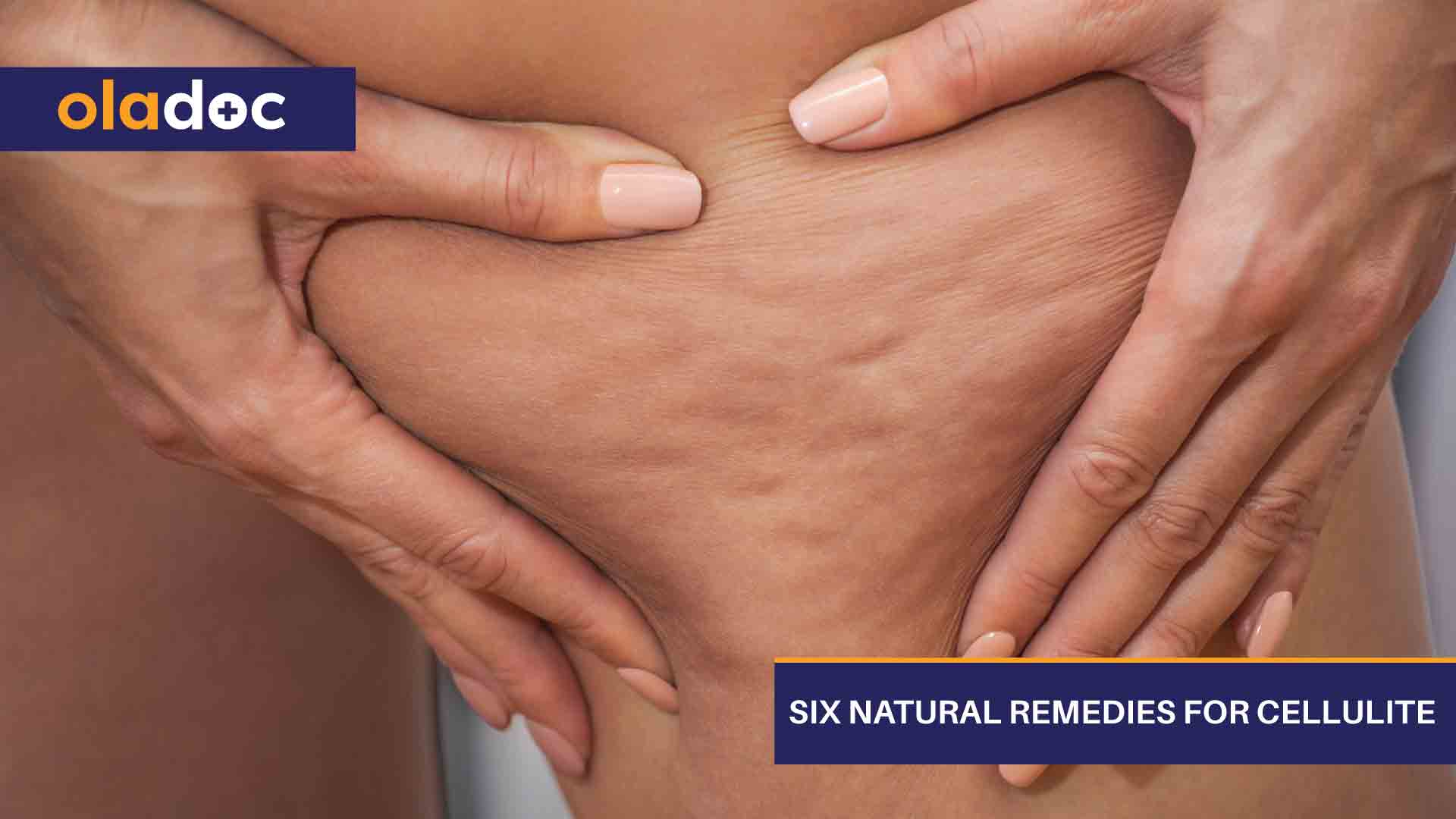 6 Natural Remedies For Cellulite thumbnail