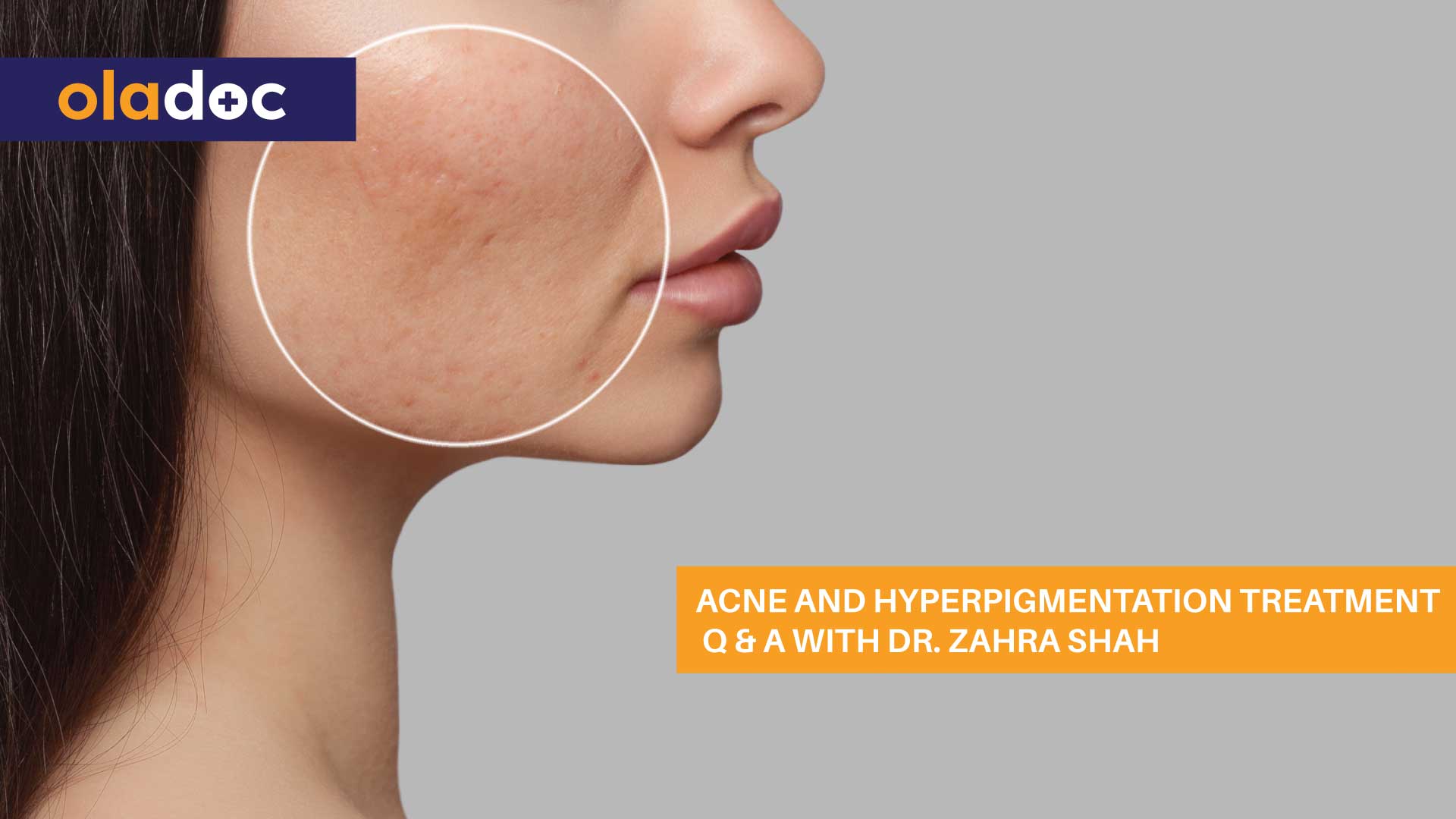 Acne And Hyperpigmentation Treatment: Q & A With Dr. Zahra Shah thumbnail