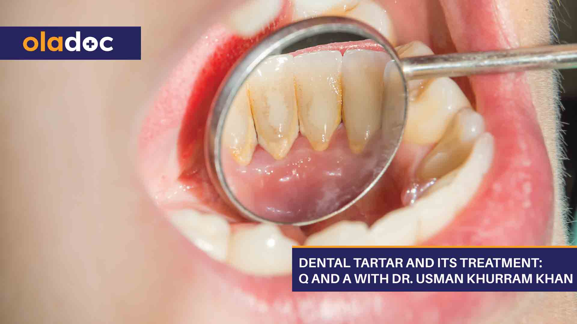 Dental Tartar And Its Treatment: Q And A With Dr. Usman Khurram Khan thumbnail