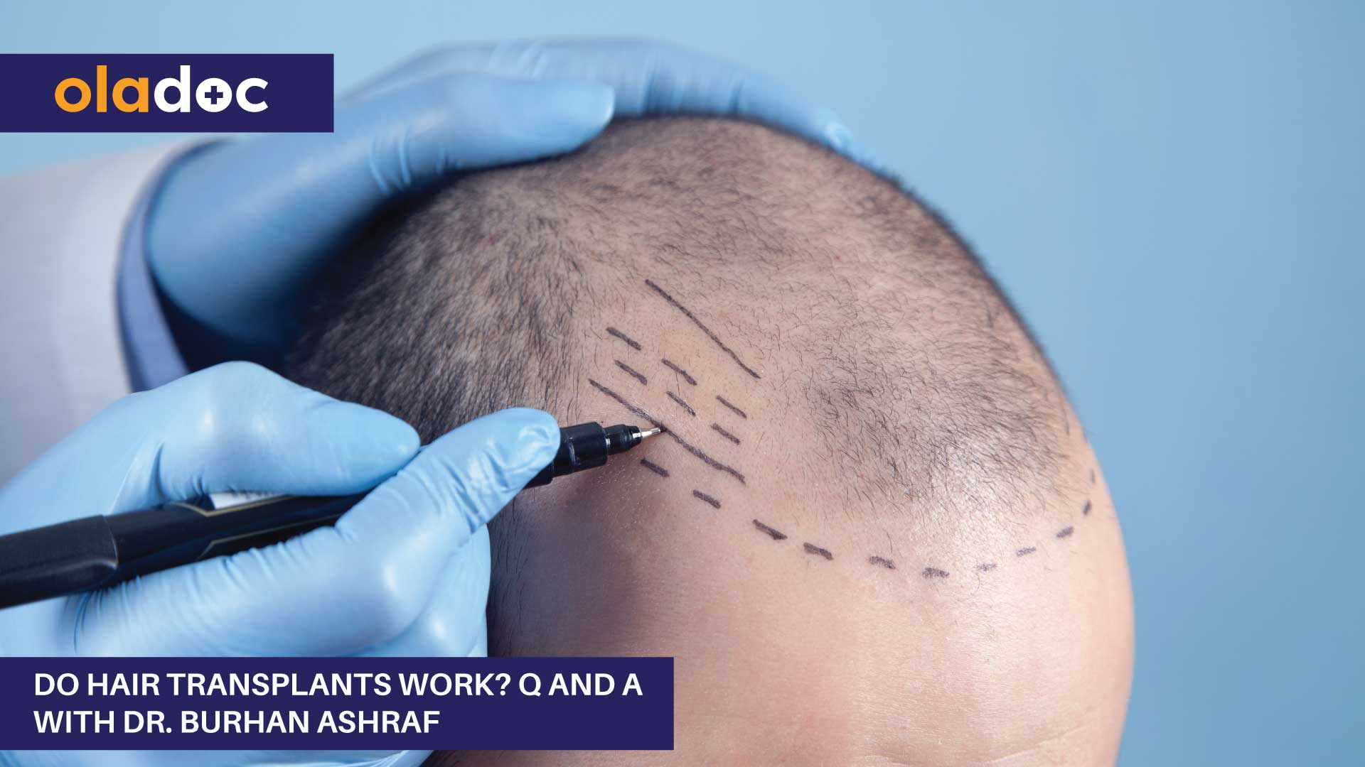 Do Hair Transplants Work? Q And A With Dr. Burhan Ashraf thumbnail