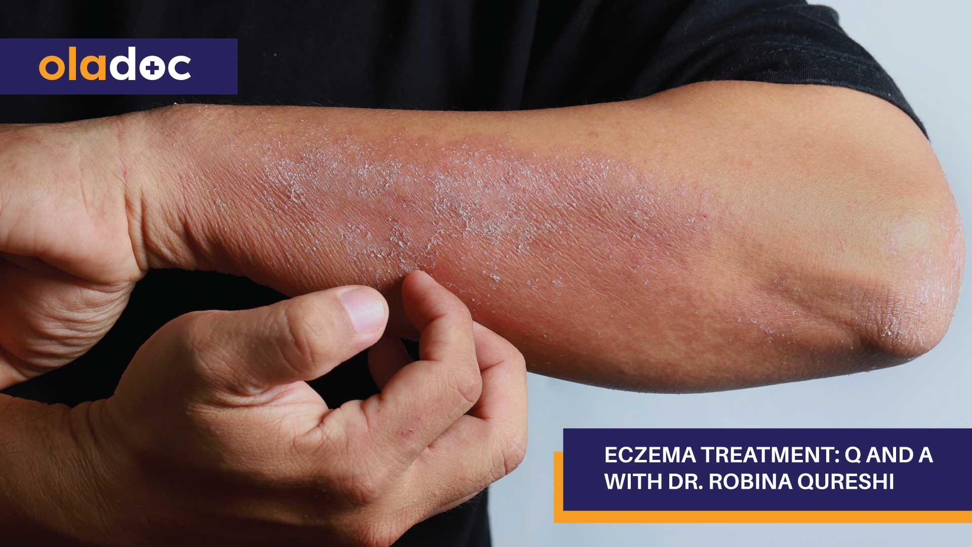 Eczema Treatment: Q And A With Dr. Robina Qureshi thumbnail