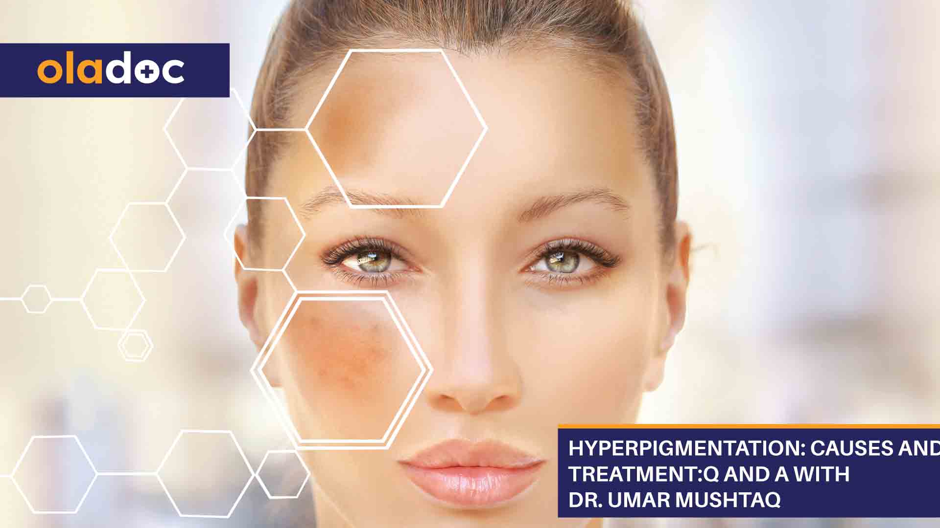 Hyperpigmentation: Causes And Treatment: Q And A With Dr. Umar Mushtaq thumbnail