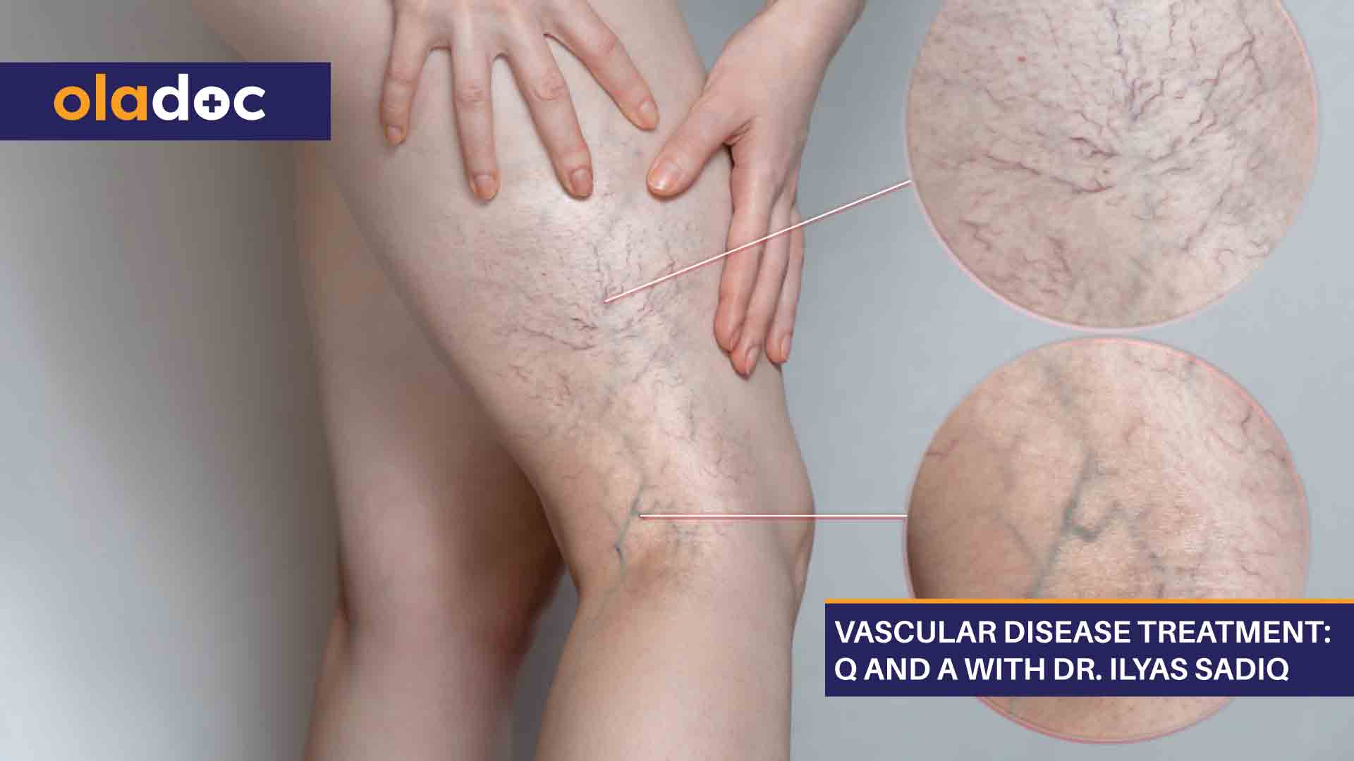 Vascular Disease Treatment: Q And A With Dr. Ilyas Sadiq thumbnail