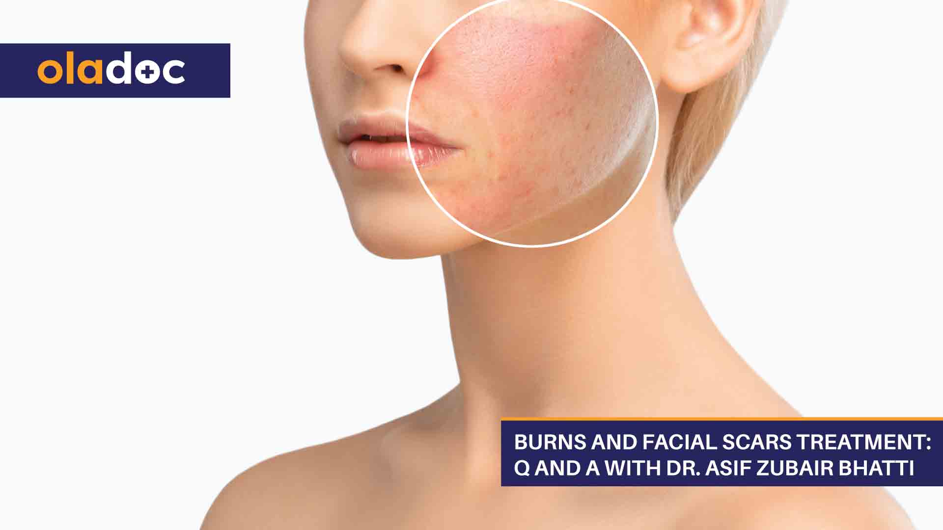 Burns And Facial Scars Treatment: Q And A With Dr. Asif Zubair Bhatti thumbnail