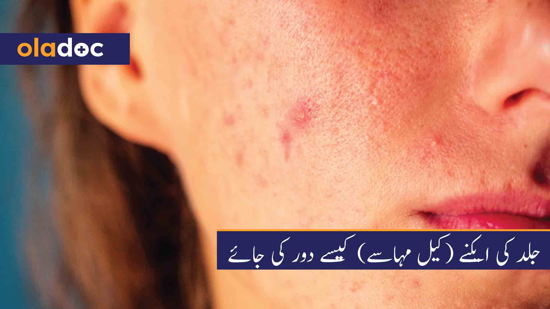 جلد کی ایکنے (کیل مہاسے) کیسے دور کی جائے thumbnail