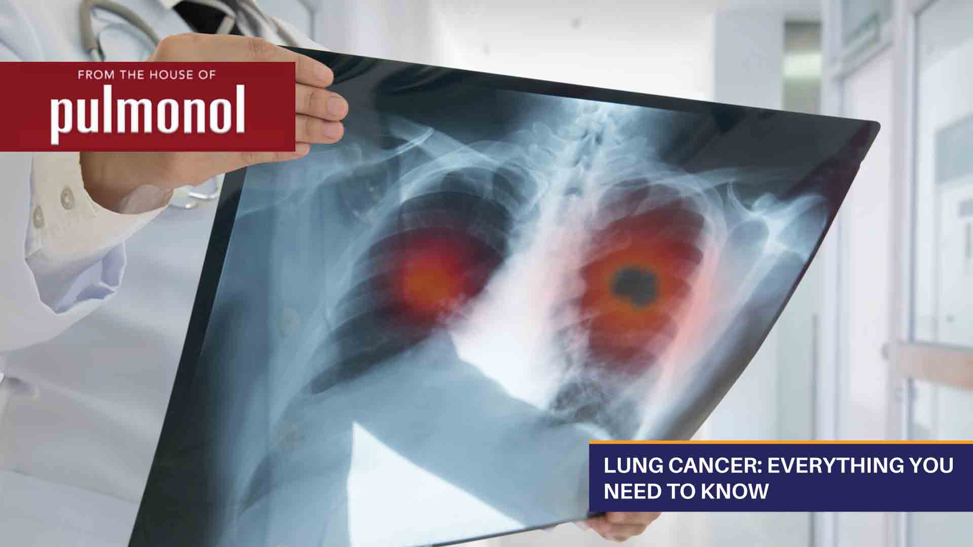 Lung Cancer: Everything You Need To Know thumbnail