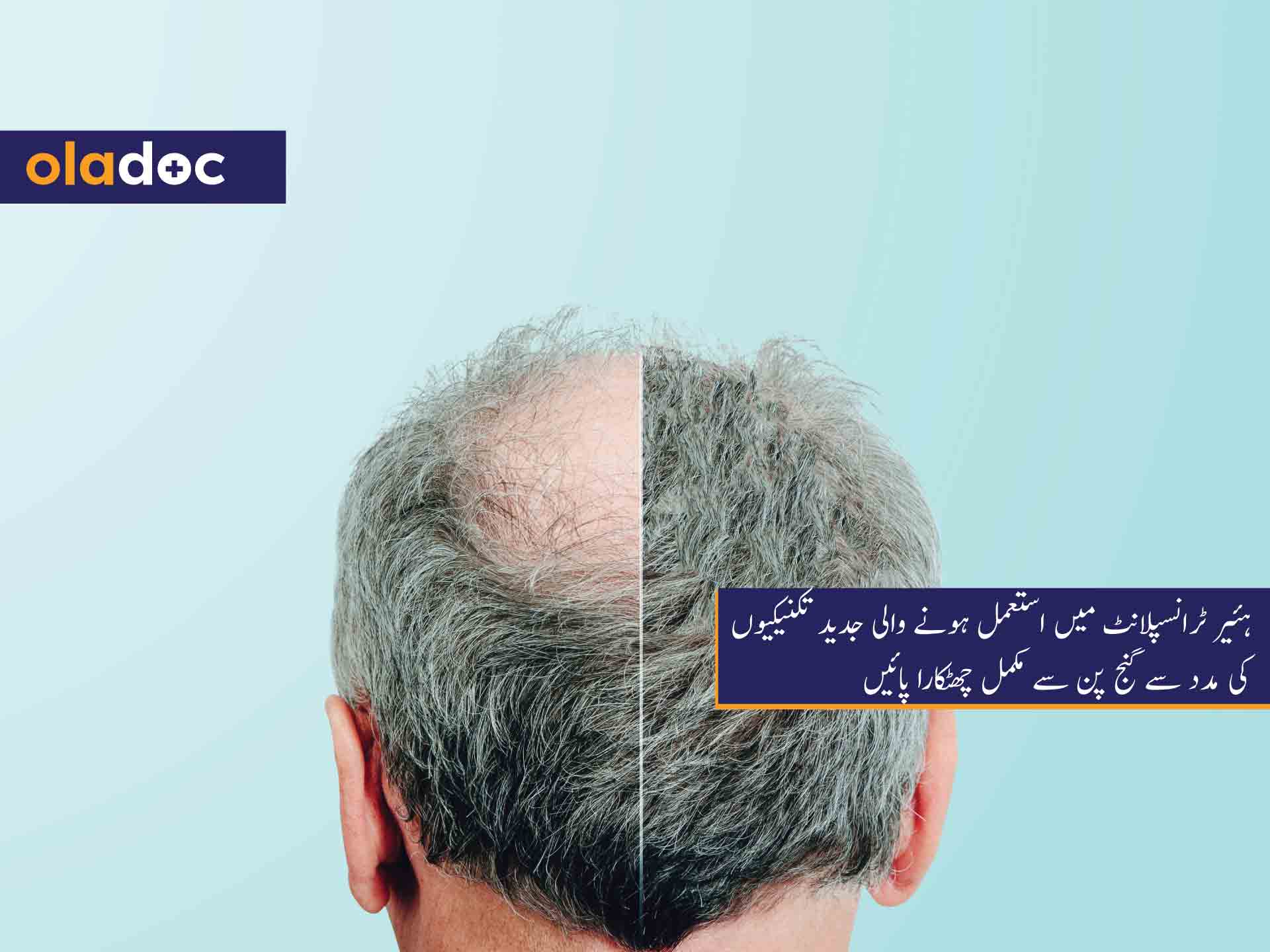 ہئیر ٹرانسپلانٹ میں استعمل ہونے والی جدید تکنیکیوں کی مدد سے گنج پن سے مکمل چھٹکارا پائیں thumbnail