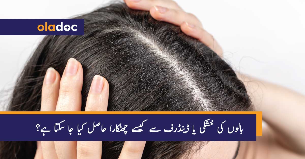 بالوں کی خشکی یا ڈینڈرف سے کیسے چھٹکارا حاصل کیا جا سکتا ہے؟ thumbnail