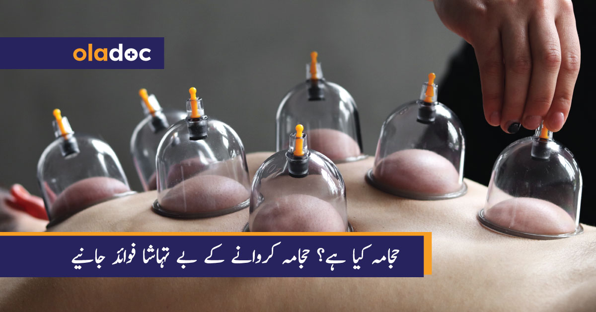 حجامہ کیا ہے؟ حجامہ کروانے کے بے تہاشا فوائد جانیے thumbnail