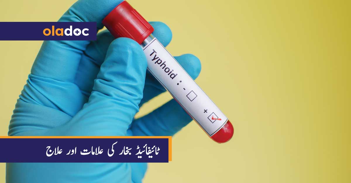 typhoid-fever