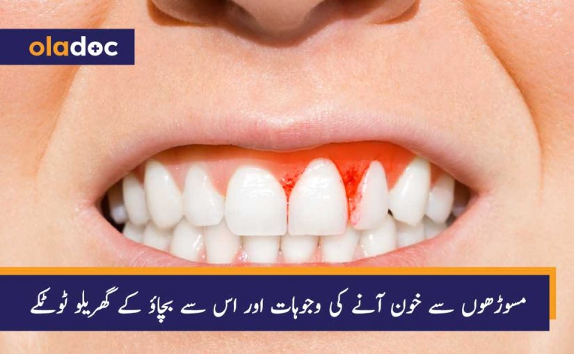 مسوڑھوں سے خون آنے کی وجوہات اور اس سے بچاؤ کے گھریلو ٹوٹکے thumbnail