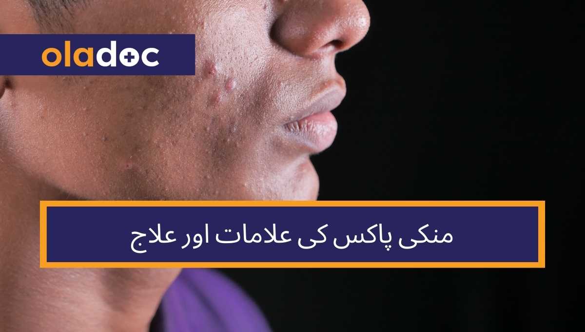 منکی پاکس کی علامات اور علاج thumbnail