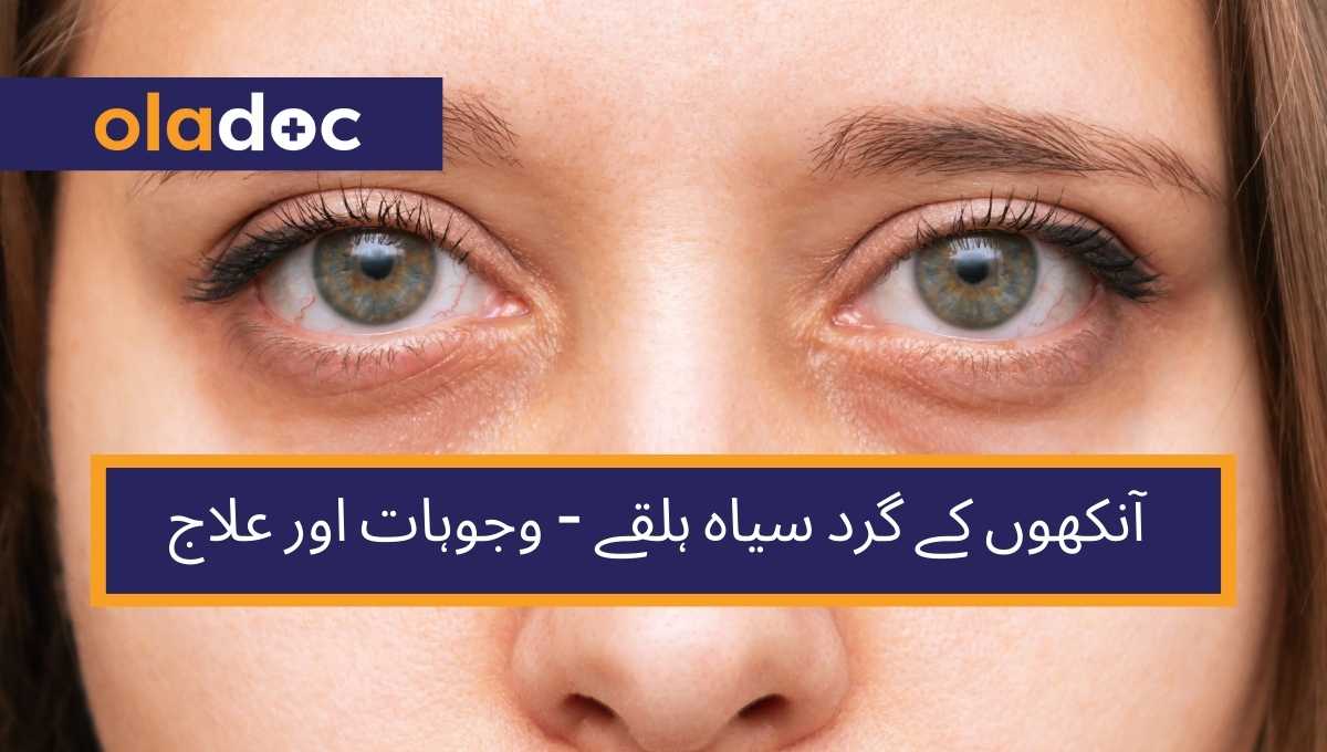 آنکھوں کے گرد سیاہ ہلقے پڑںے کی وجوہات اور علاج thumbnail