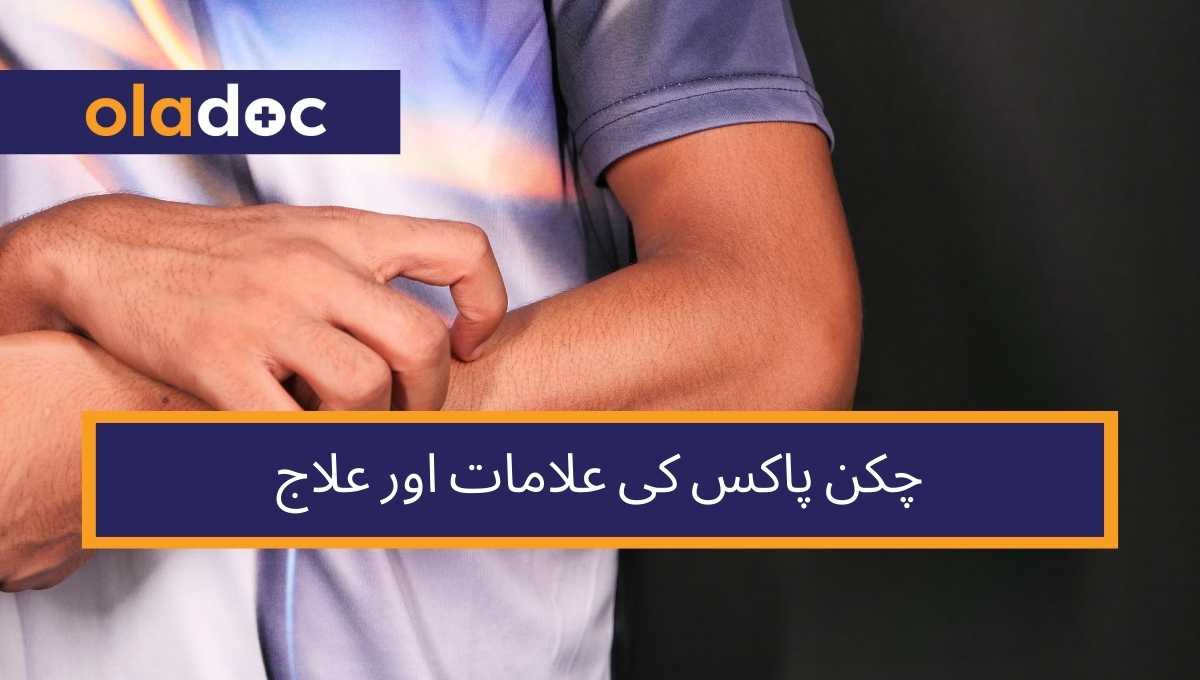 چکن پاکس کی علامات اور علاج thumbnail