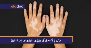 Vitiligo