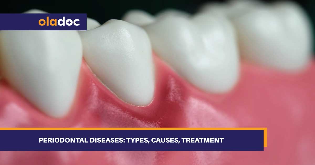 Periodontal Diseases: Types, Causes, Treatment thumbnail