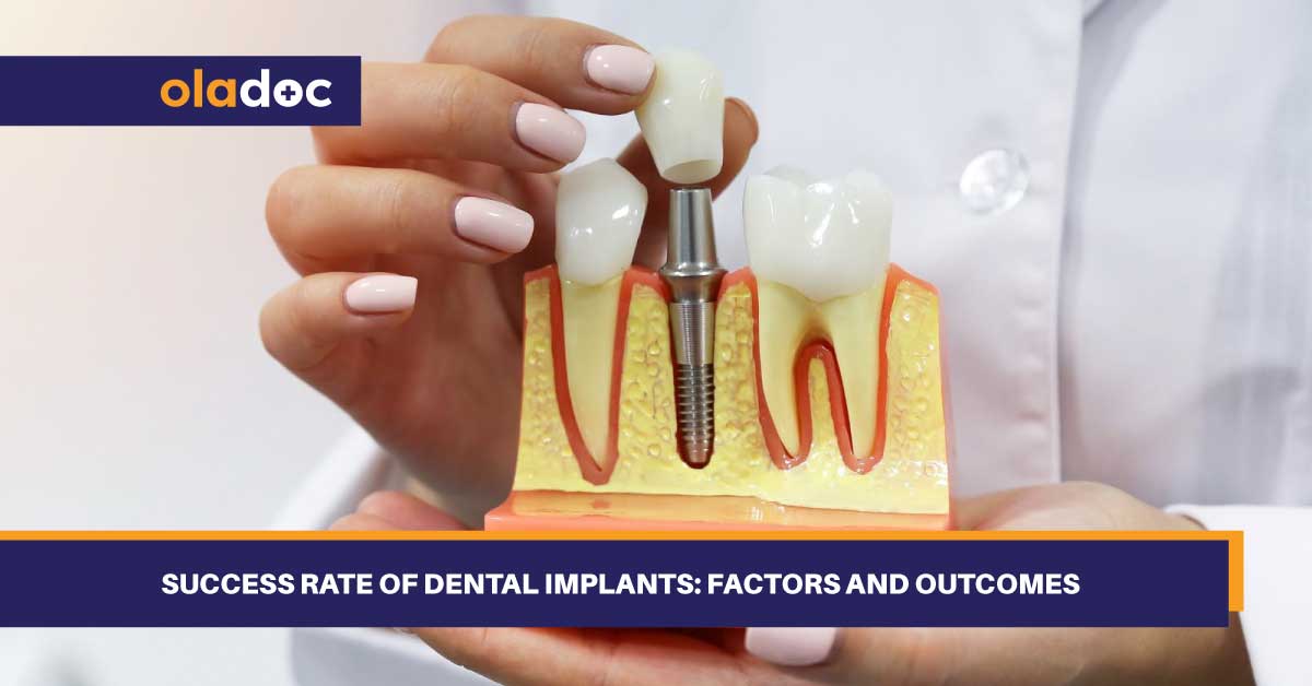 Success Rate Of Dental Implants: Factors And Outcomes thumbnail