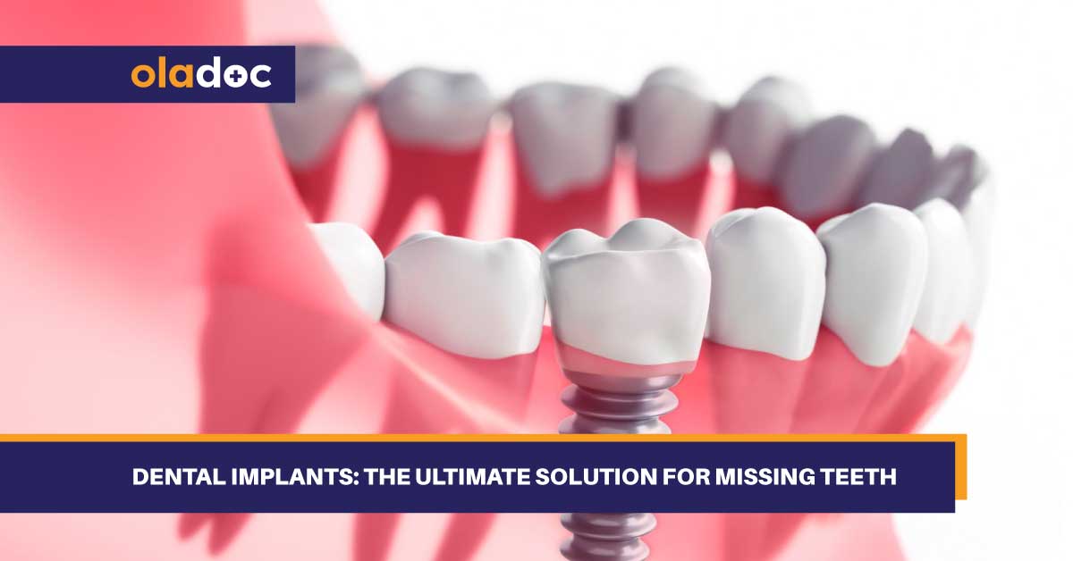 Dental Implants: The Ultimate Solution For Missing Teeth thumbnail