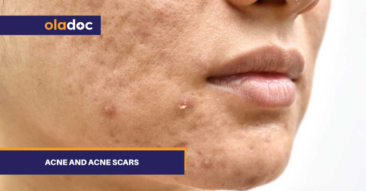 Acne and Acne Scars: Management and Treatment thumbnail