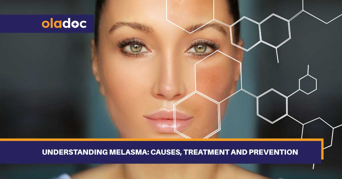 Understanding Melasma: Causes, Treatment and Prevention thumbnail
